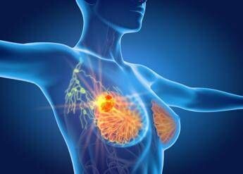 Per cancro seno la cura che arriva dal gelo, Ieo: “Verso un futuro no bisturi”