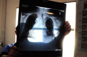 Tumori, in Italia 395mila casi nel 2023, ondata diagnosi post pandemia e -3% screening