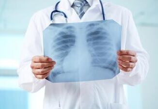 Adenocarcinoma polmonare svelata carta didentita della variante mucinosa