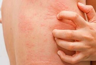 Fake news sull'orticaria, l'immunologo: "Diffidare dai test farlocchi" 3 Fake news sullorticaria limmunologo Diffidare dai test farlocchi