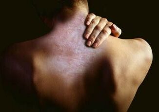 APIAFCO denuncia lingiustificata assenza della psoriasi dallaggiornamento del Piano Nazionale Cronicita. Una discriminazione che nega diritti e dignita a 18 milioni di italiani