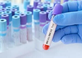 Cancro seno con mutazione Brca 88 pazienti trattati con Olaparib e vivo a 6 anni