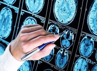 Sogni scudo anti Alzheimer Ritardo sonno Rem possibile spia precoce malattia