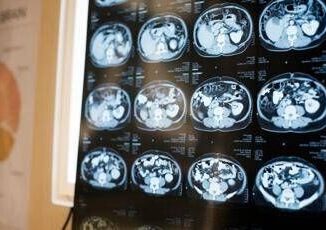 Neurologi Noi fondamentali in gestione neoplasie cerebrali