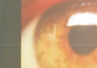 Rilancio Holostem terapia salva cornea a 1 paziente e gia altri in lista