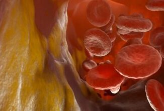 Studio italiano terapia a Rna riduce colesterolo Ldl di oltre 60
