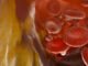Studio italiano terapia a Rna riduce colesterolo Ldl di oltre 60