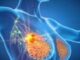 Cancro al seno metastatico da anticorpo coniugato due nuove speranze