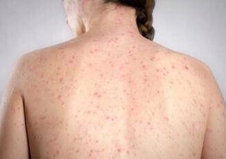 Morbillo la verita sulla vitamina A Non riduce il rischio di contrarre la malattia