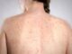 Morbillo la verita sulla vitamina A Non riduce il rischio di contrarre la malattia