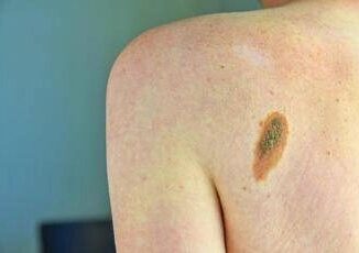 Ok Aifa a immunoterapia in fase precoce per melanoma e carcinoma polmonare
