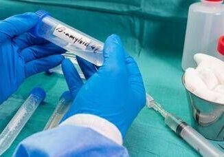 Ricerca nella saliva 2 spie della demenza a corpi di Lewy studio Sapienza