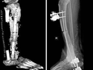 Batterio gli mangia la carne operazione al Gemelli gli salva gamba e piede