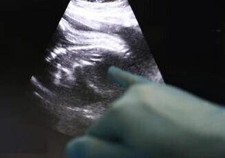 Trapianti Uk Amy prima bimba nata da donazione di utero da vivente