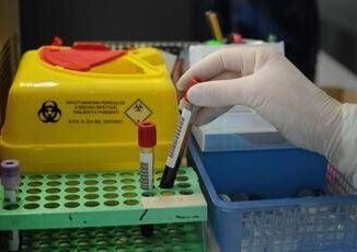 Alzheimer via libera a test del sangue per diagnosi cosa significa