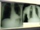 Cancro polmone a piccole cellule ok Ue a tislelizumab