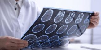 Sclerosi multipla per 144mila italiani 10 e fuori da percorsi cura e assistenza