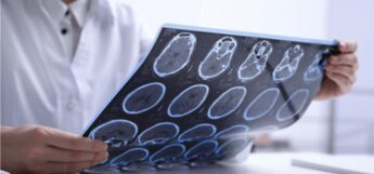 Sclerosi multipla per 144mila italiani, 10% è fuori da percorsi cura e assistenza