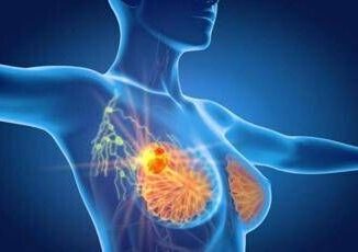 Tumore al seno triplo negativo speranze da anticorpo farmaco coniugato