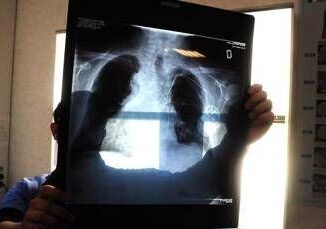 Tumori in carcinoma polmonare risultati positivi da combinazione in prima linea